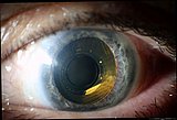 Epi Ret III Sehprothese im Auge
