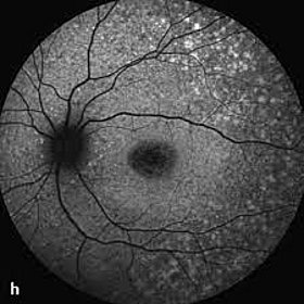 Die Zellschicht des retinalen Pigmentepithels ist zu sehen.